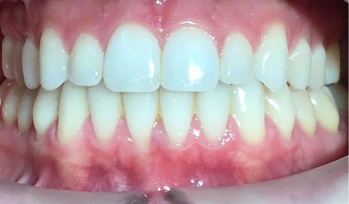 patient teeth after treatment