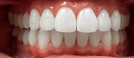 perfect teeth
