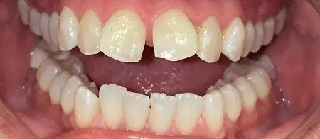 crooked teeth